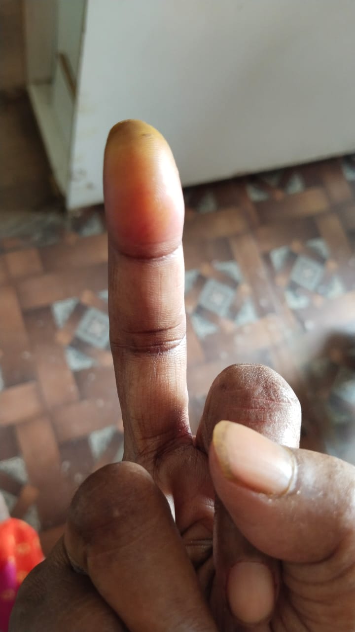 Devi Before Treatment